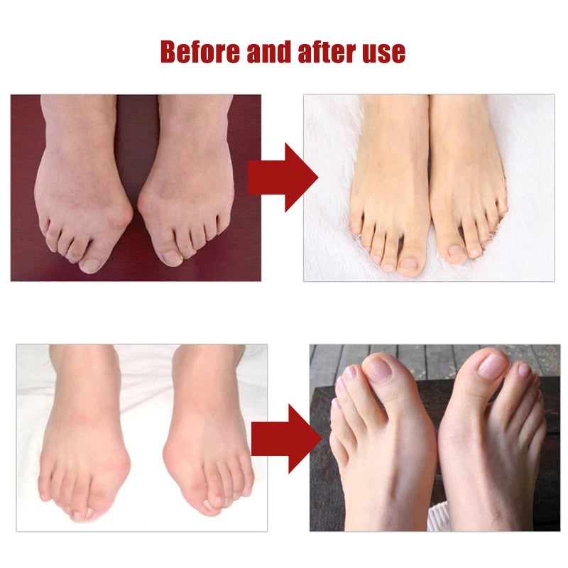 Bunion Corrector